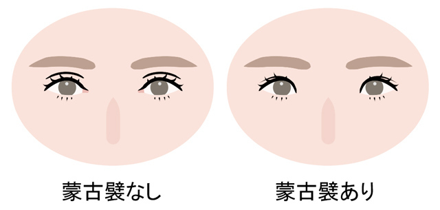 目頭の切れ込み・切開ラインは生まれつき？